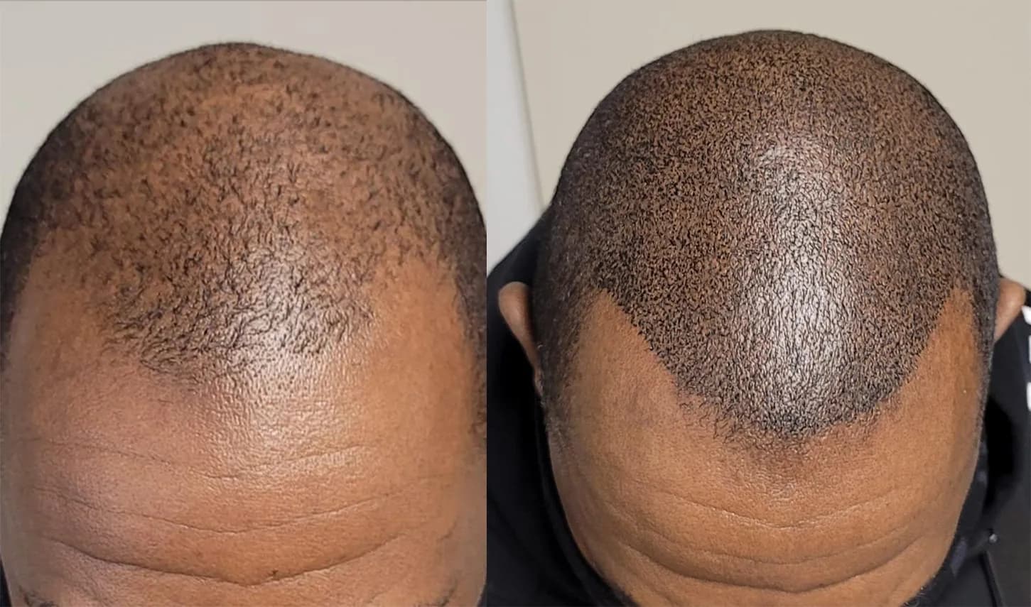 Hair Transplant Medical Centre Mississauga & Toronto | Hair Loss Treatment — scalp micropigmentation studio in Mississauga